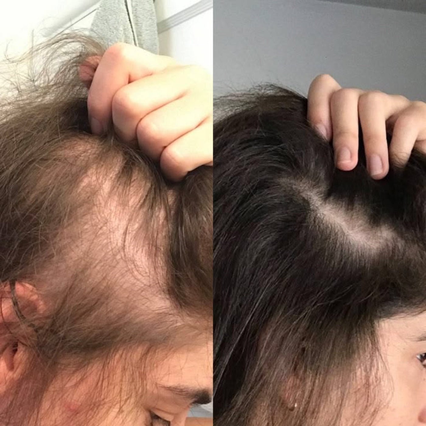 Baby hairs filling the hairline