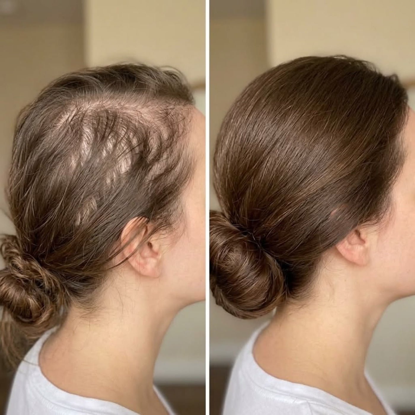 Thinning crown filled in